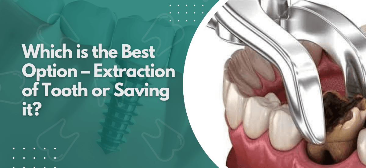 Which is the Best Option – Extraction of Tooth or Saving it?