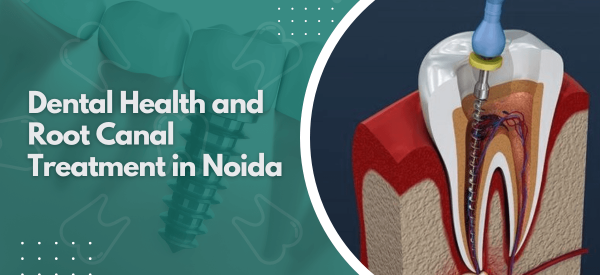 Dental Health and Root Canal Treatment in Noida