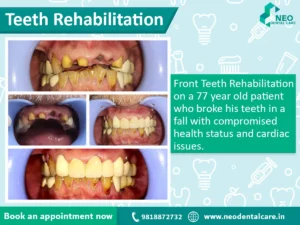 before and after teeth rehabilitation