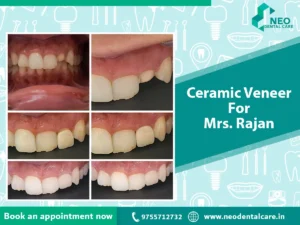 Ceramic Veneer for Mrs. Rajan