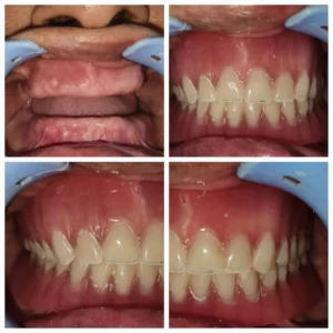 Rehabilitation with Complete Dentures
