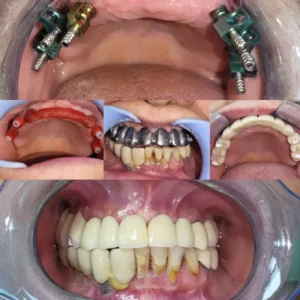 Before and After Dental Rehabilitation