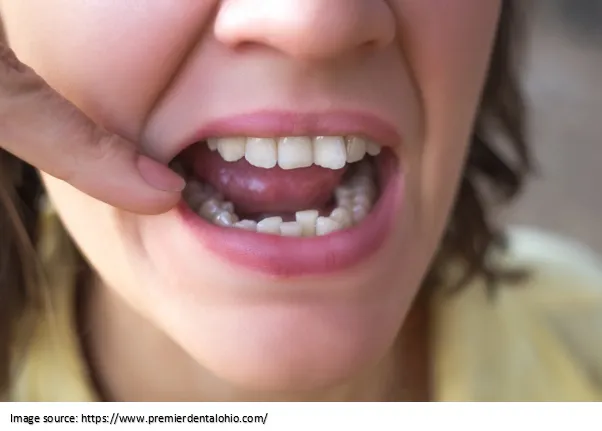 Misaligned Teeth – Causes and Treatment Options