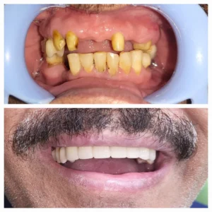 before and after procedure