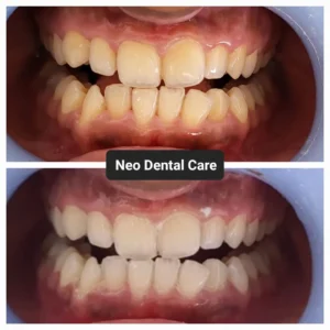 before and after teeth cleaning