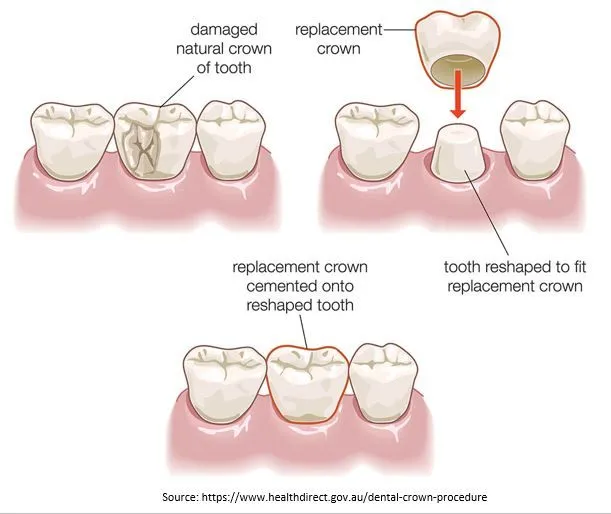 Dental Crown Replacement