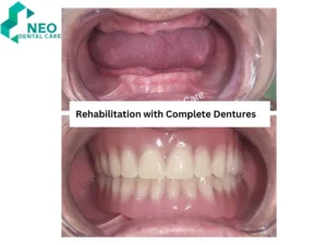 rehabilitation with complete dentures