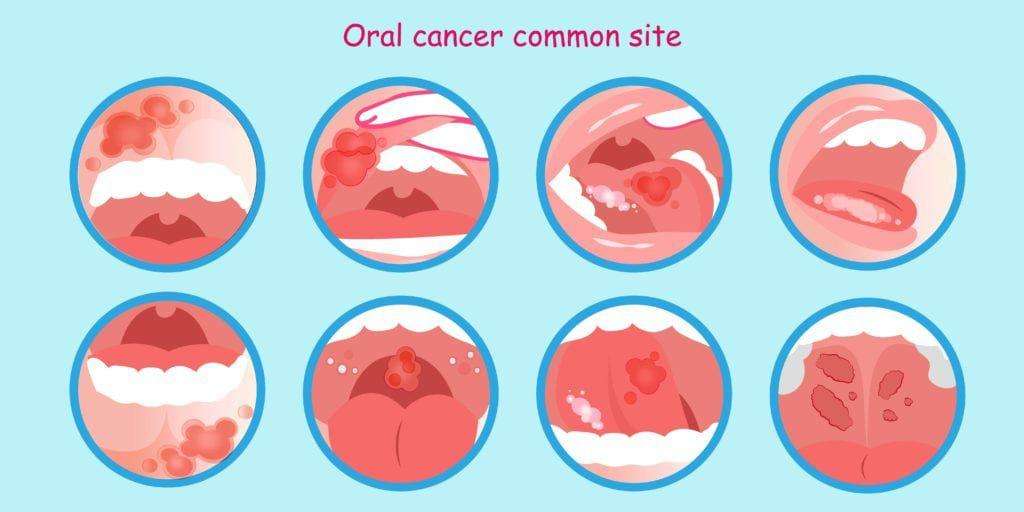 Oral cancer common site