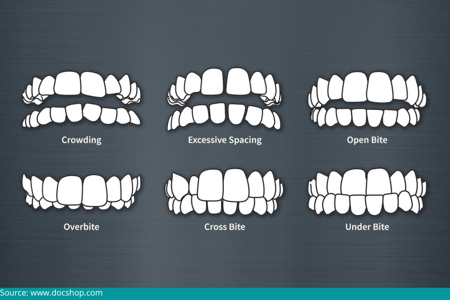 Tooth Alignment for Adults