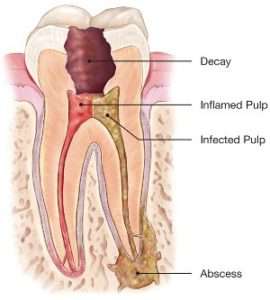 decay tooth root canal