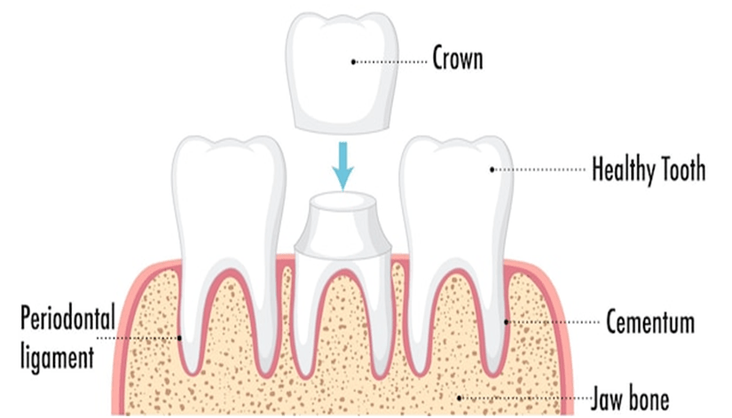 Dental Crowned Teeth