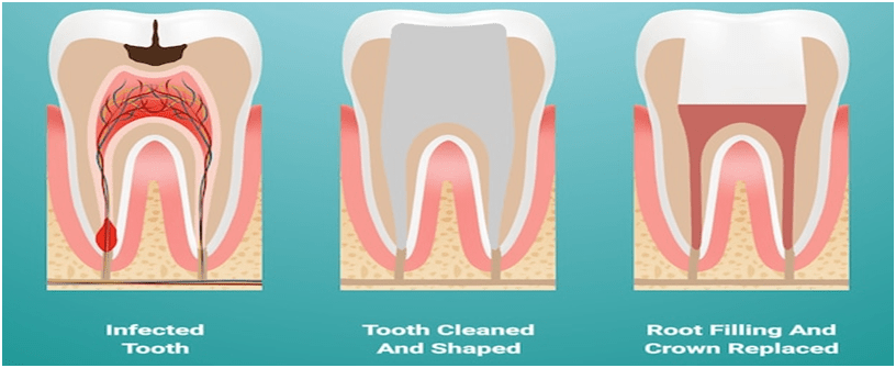 Root Canal on Crowned Tooth | Neo Dental