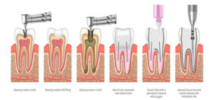 During treatment of root canal