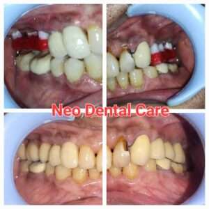 Dental Implant