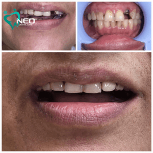 Tooth Replacement with dental Implants