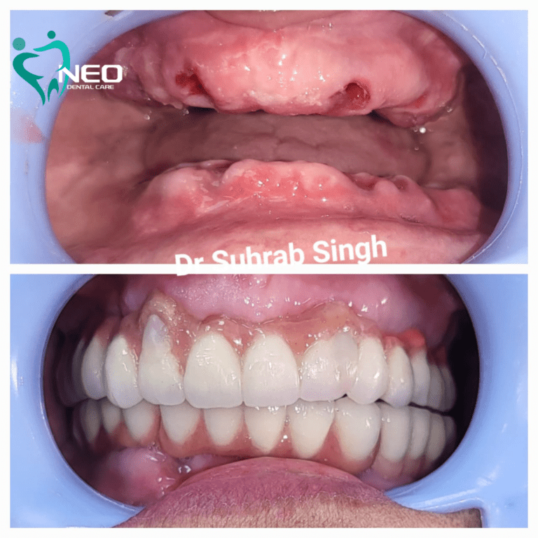 Full mouth rehabilitation with All on 6 Dental Implants and Ceramic Crowns