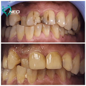 Correction of function and Aesthetics using All Ceramic Layered Crowns.