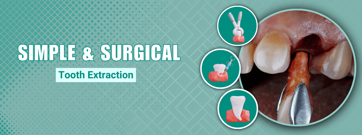 Simple & Surgical Tooth Extraction in Noida | Neo Dental Care