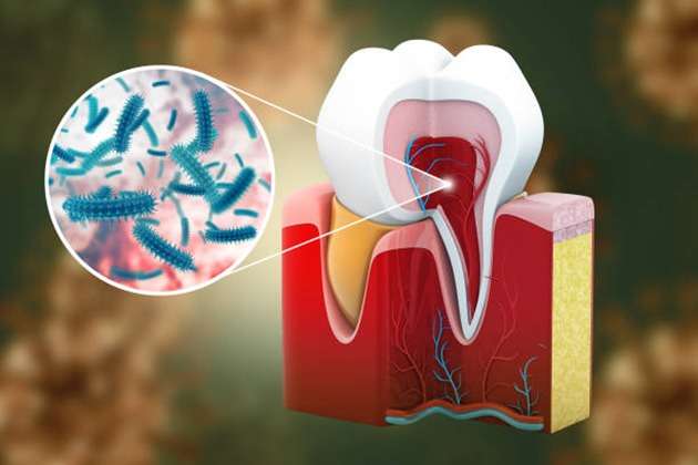 Causes of Jaw Pain 2 weeks After Root Canal