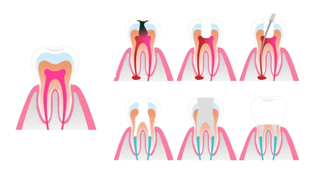 Jaw Pain 2 Weeks After Root Canal