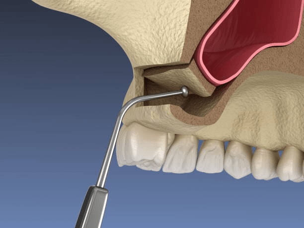 Lateral Window Sinus Augmentation