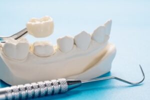 Dental Crown Treatment