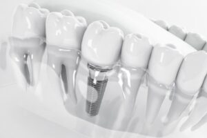 Dental Implant