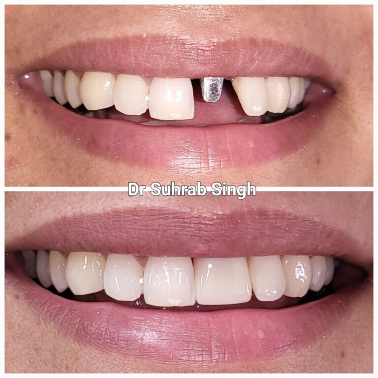 Front tooth replacement with dental implant And zirconia all ceramic crown