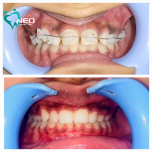 Orthodontic correction using Braces