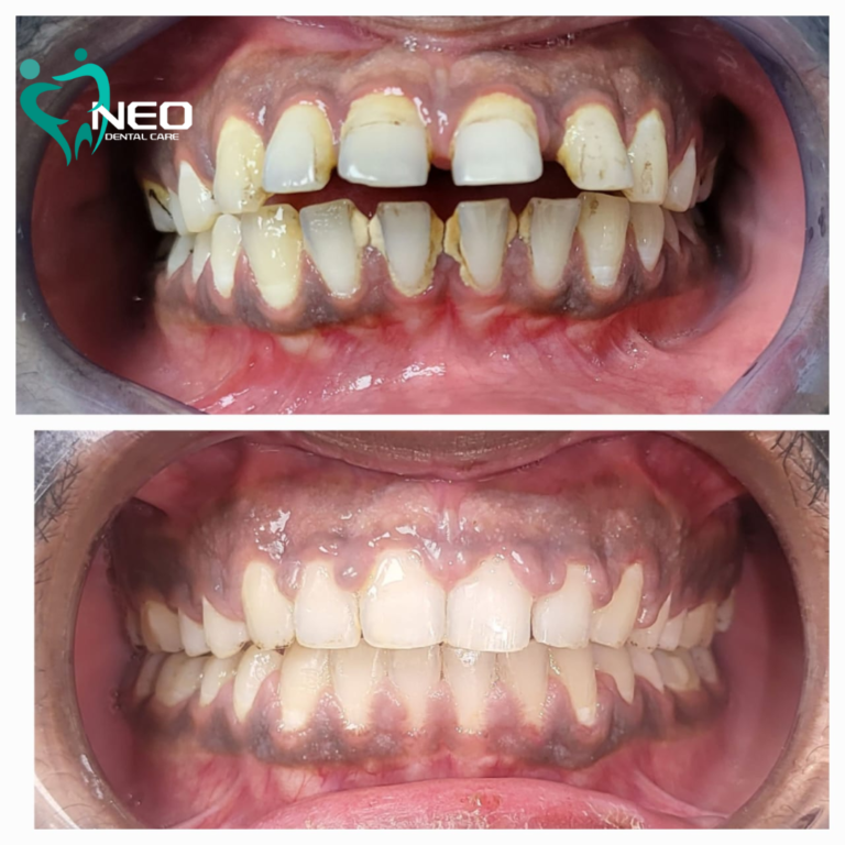 Orthodontic correction using invisible Aligners