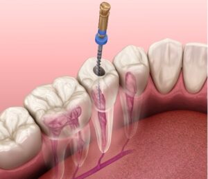 Root Canal Treatment