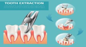 Simple & Surgical Tooth Extraction