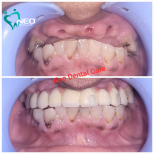 Upper Arch rehabilitation using Dental Implants.