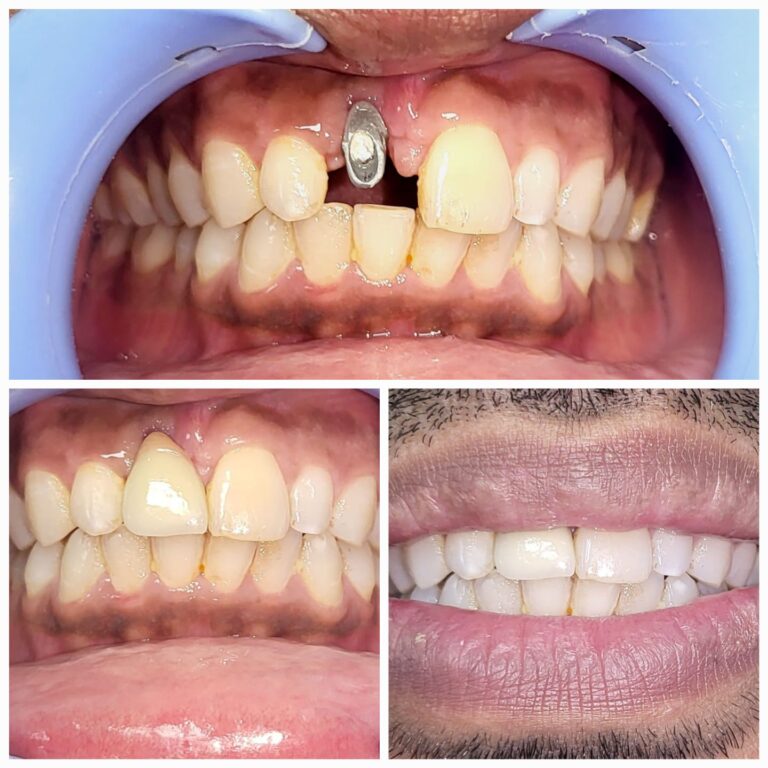 Upper front tooth replacement with Dental Implant and Zirconia Layered crown