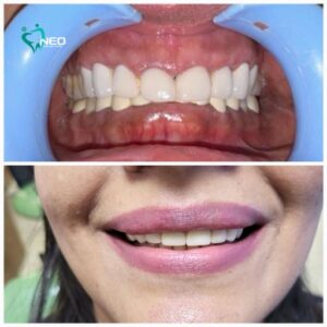 Smile designing with All Ceramic Crowns