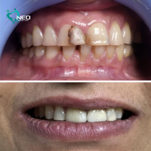 Aesthetic Smile Makeover using lidisi Veneers