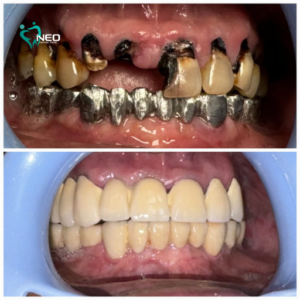 Full mouth rehabilitation using Dental Implants with lower arch and ceramic crowns with upper arch