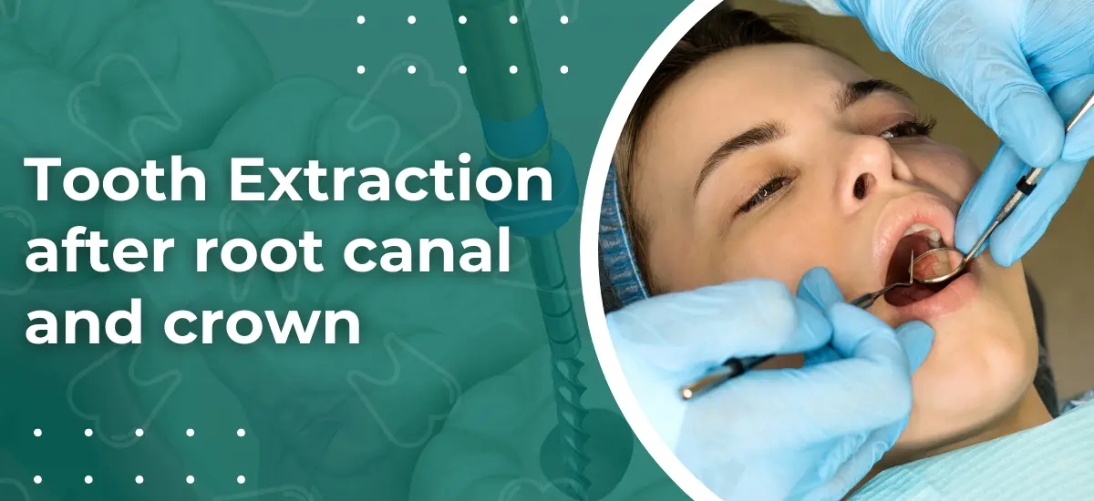 Tooth Extraction after root canal and crown