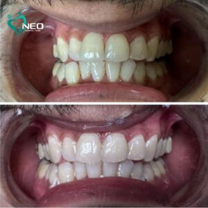 Laser teeth whitening before and after
