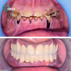 Full mouth rehabilitation using facebow and semi adjustable articulator