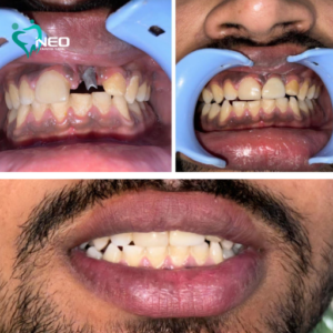 Implant rehabilitation of missing front tooth with perfect shade and shape