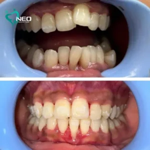 Orthodontic correction Using invisible Aligners