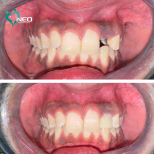 Aesthetically restoring missing tooth with an implant emax crown