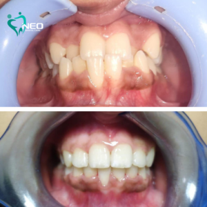 Orthodontic correction using invisible Aligners