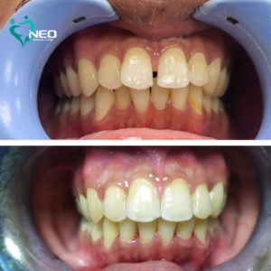 Orthodontic correction using invisible Aligners