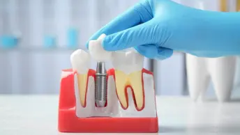 Dental Implants