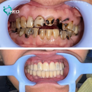 Full mouth rehabilitation with dental implants in a cancer survivor patient with grossly carious and poor prognosis teeth