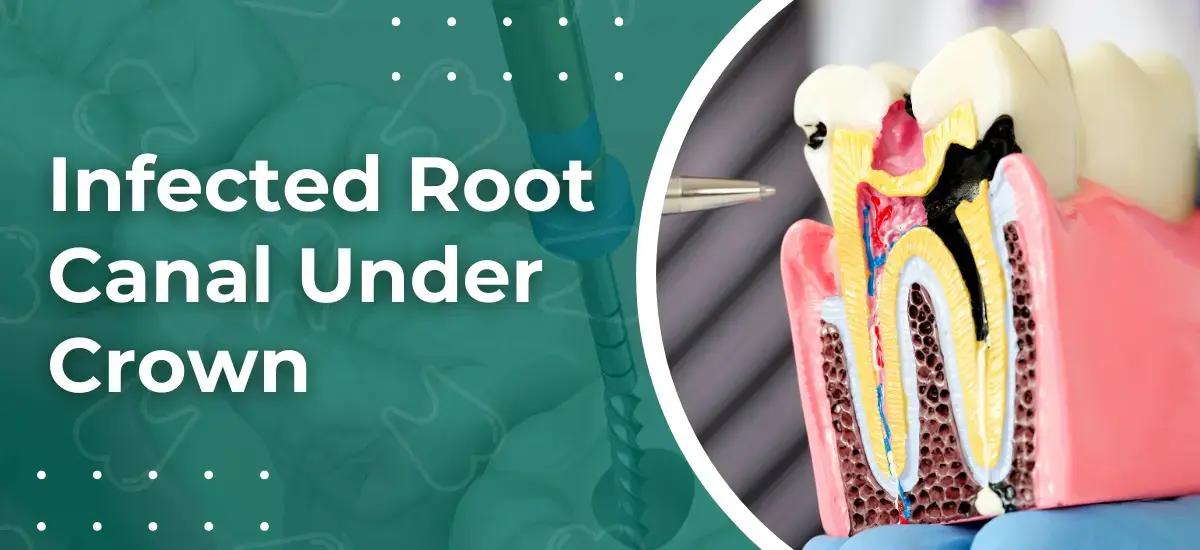 Infected Root Canal Under Crown