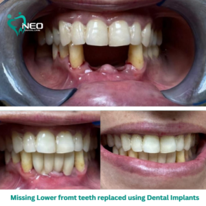 Missing Lower fromt teeth replaced using Dental Implants