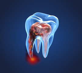 How is an Infected Root Canal Under a Crown Diagnosed?